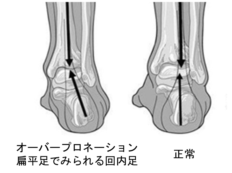 足裏のアーチが低下している